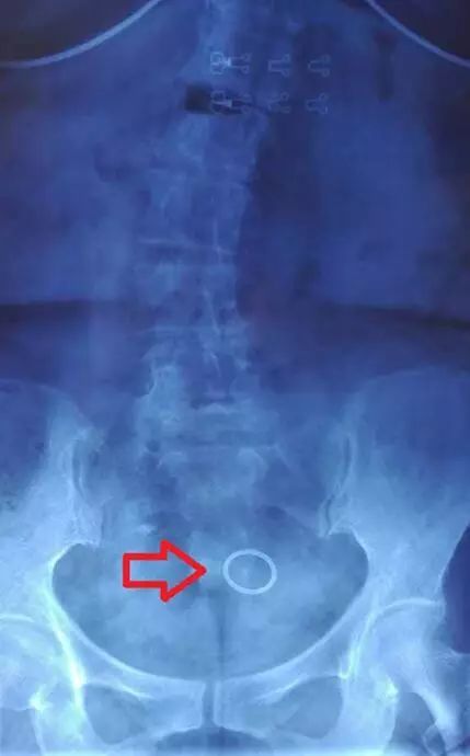 有节育环能否做胸腔核磁共振,有节育环能否做膝盖核磁共振