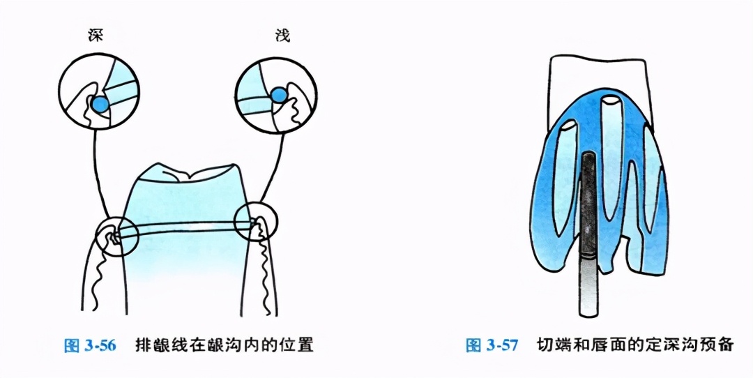 口腔金属冠与全瓷冠的区别,牙科医生讲义