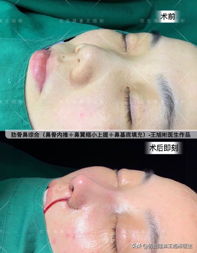 短鼻延长,短鼻塌鼻可以逆袭变长吗