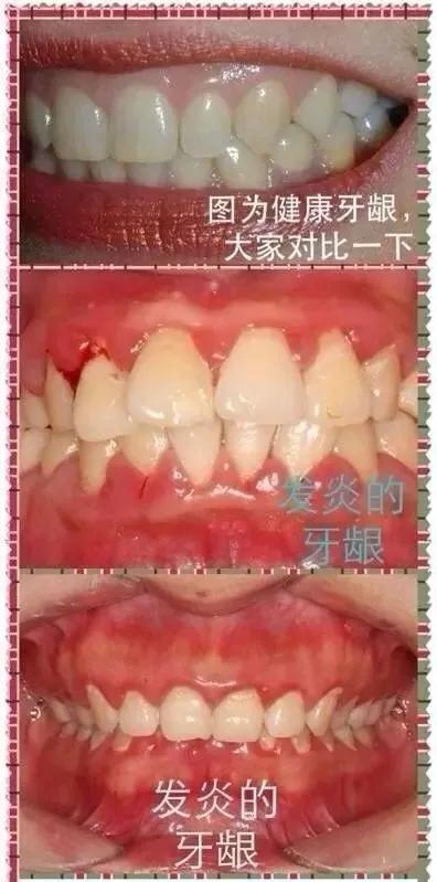 牙科治疗牙龈炎的效果怎么样,Helen齿科中心