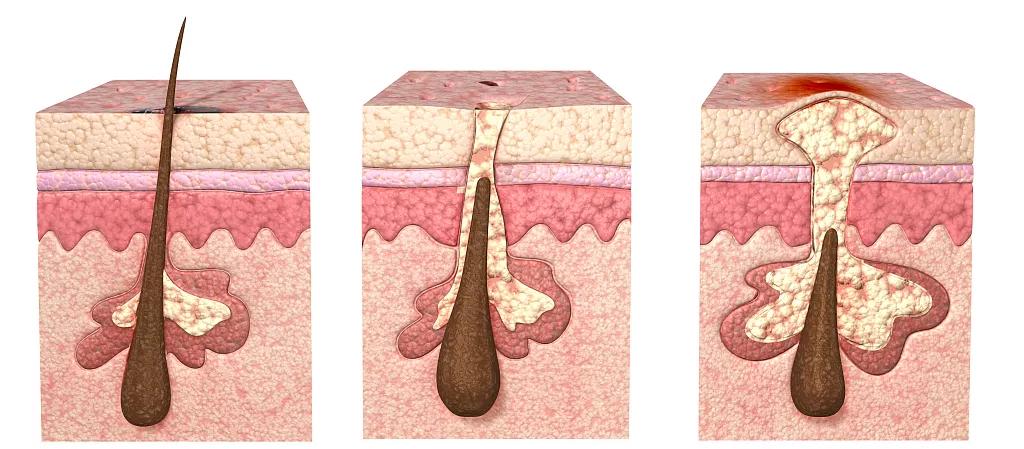 辟谣、吃酱油加深痘印？芦荟胶治好痘坑？别傻了！