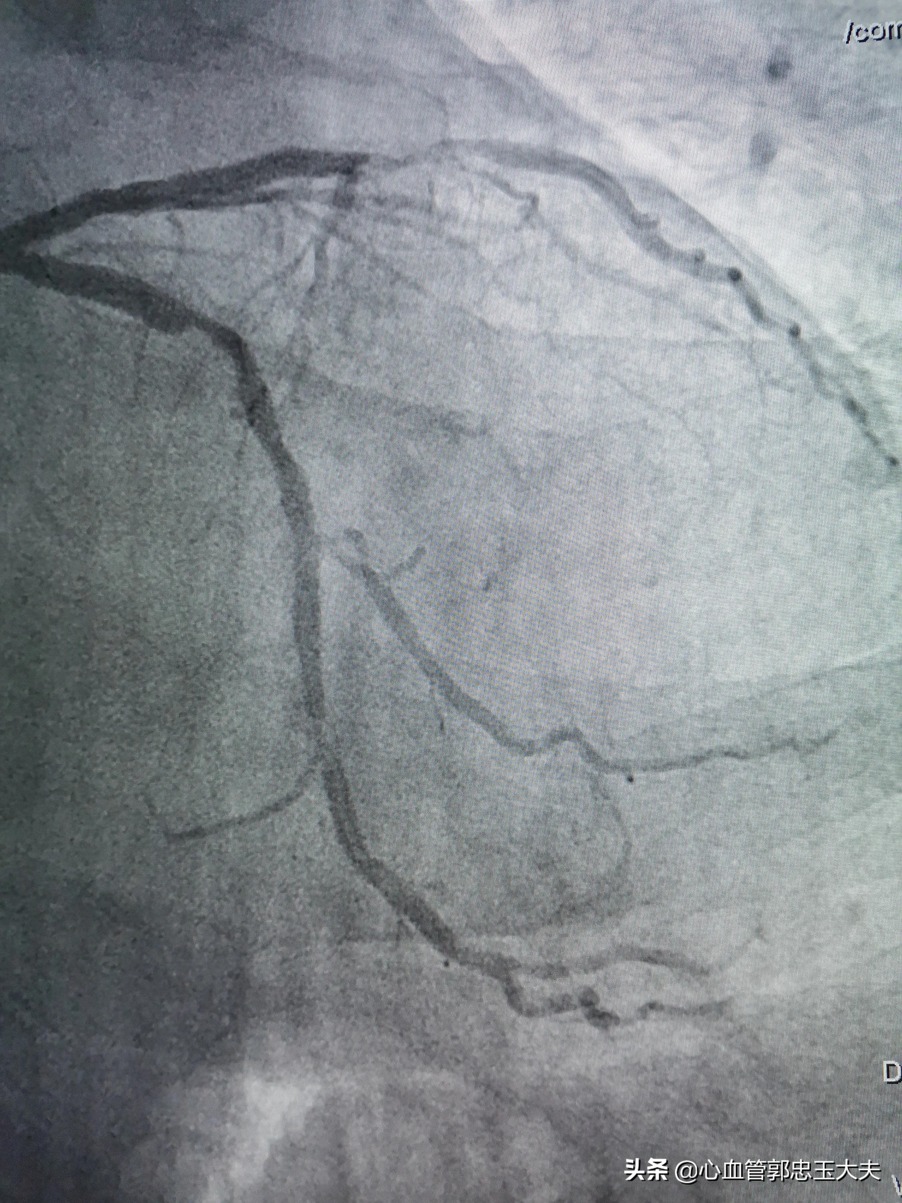 CTO遇到钙化病变怎样才能把血管打通？