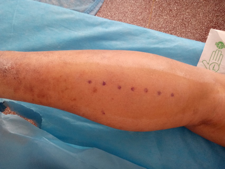 足跟痛应该怎么治疗最好,足跟痛怎么治呢