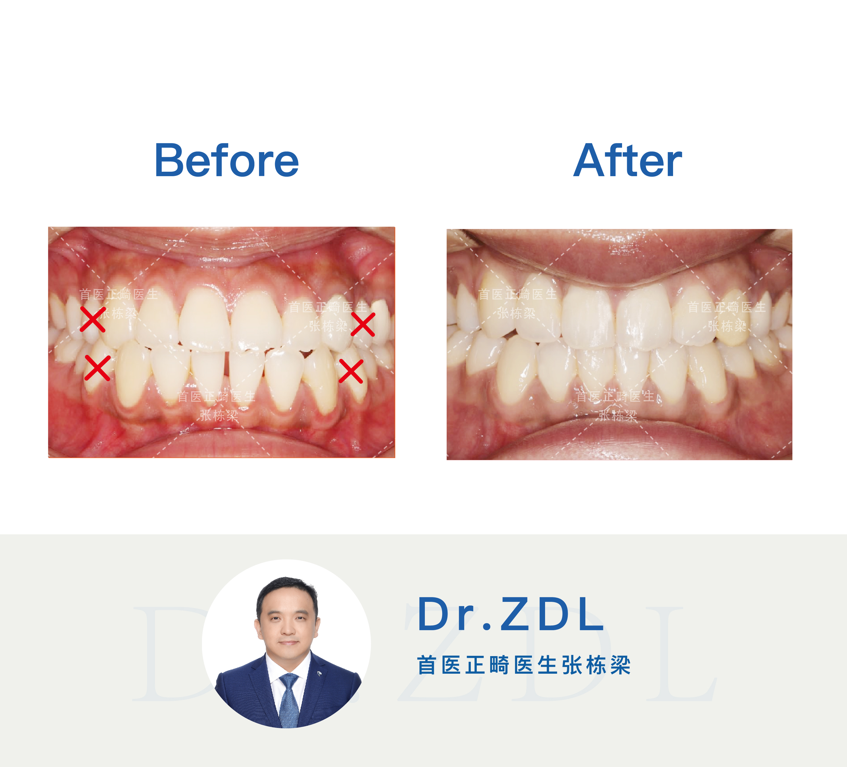 做了烤瓷桥还能正颌吗,做了烤瓷桥还能做钢牙吗