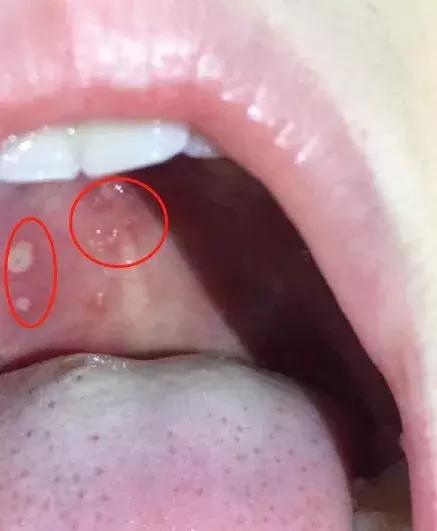 手足口喝利巴韦林管用吗,利巴韦林可以治手足口吗