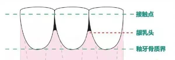 牙齿黑三角怎么补救,牙齿上的黑三角怎么改善