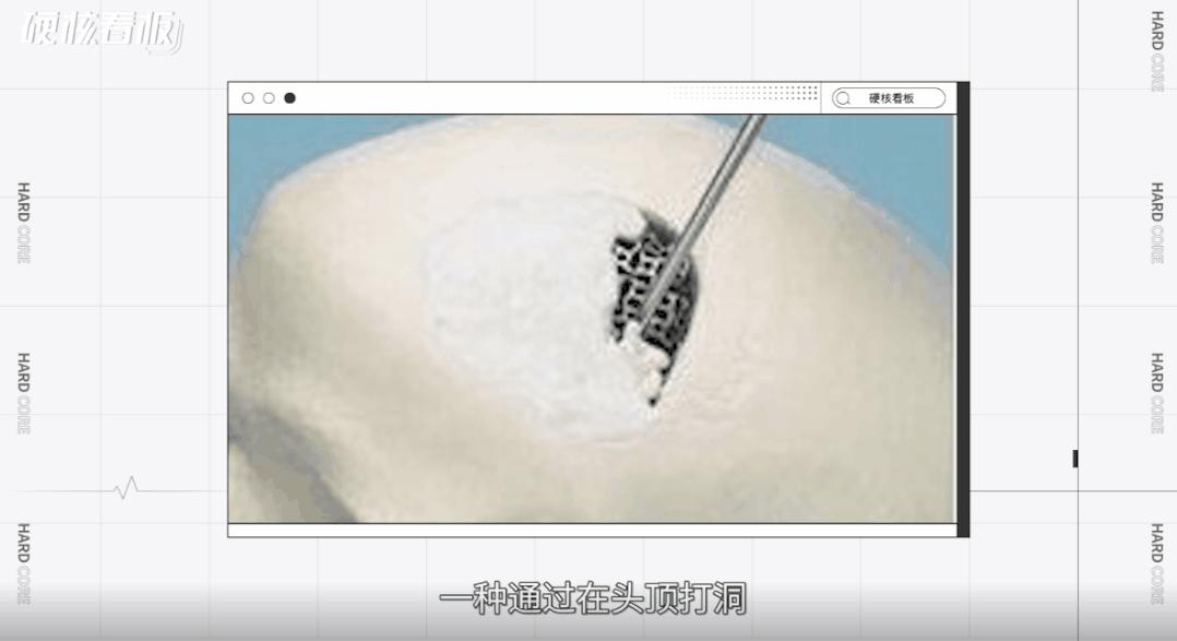 划开头皮、切断肌肉,为了美她们能做到什么程度?