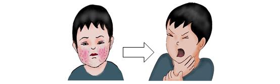 宝宝食物过敏红疹一般要多久好,如何发现宝宝对食物过敏了