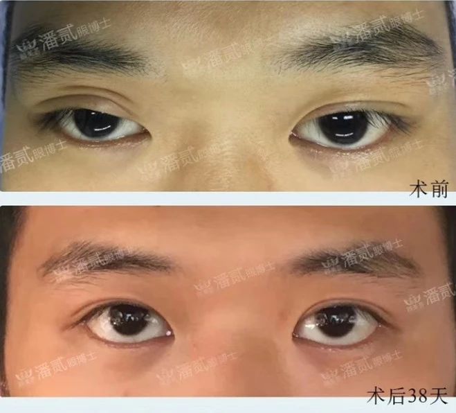 双眼皮失败的女孩,双眼皮失败做成了三眼皮好修复吗