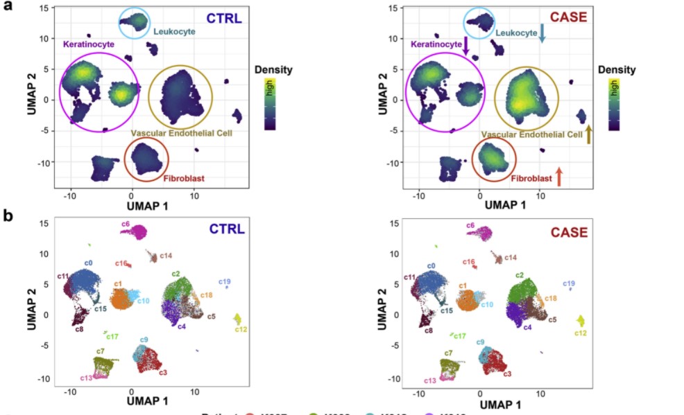 瘢痕疙瘩发病原因,皮肤瘢痕症