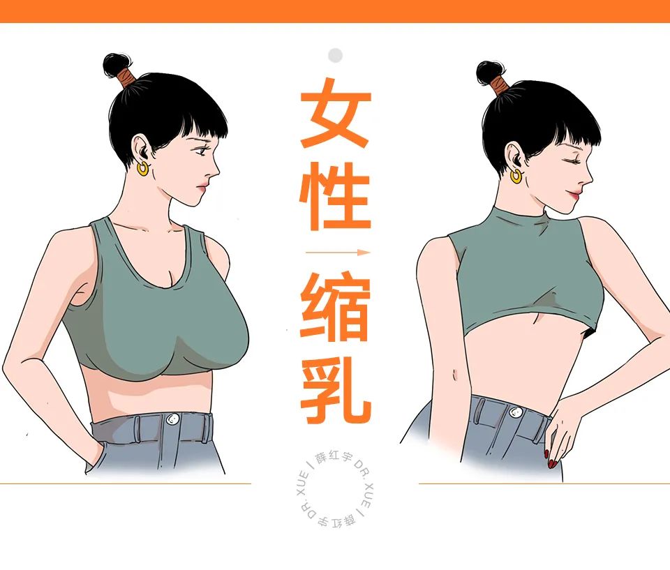 乳房缩小整形适合人群,乳房缩小术可能造成的并发症