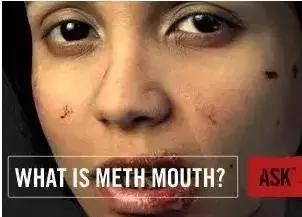 原来牙齿能让*毒冰**原形毕露！牙医：发现这种牙况特征请小心远离