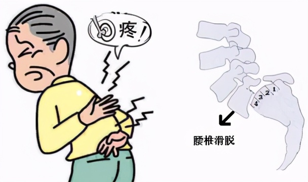 腰椎滑脱吃什么药,腰椎滑脱复位视频