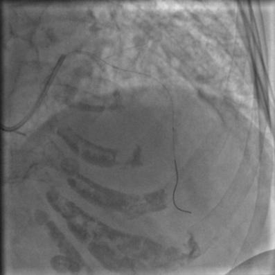 85岁老人心脏堵塞,77岁老人冠脉狭窄放支架还是搭桥