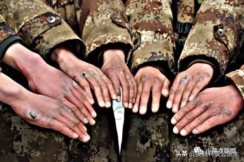 冻伤后痒痒是怎么回事,冻疮后期接触水干燥发痒怎么治