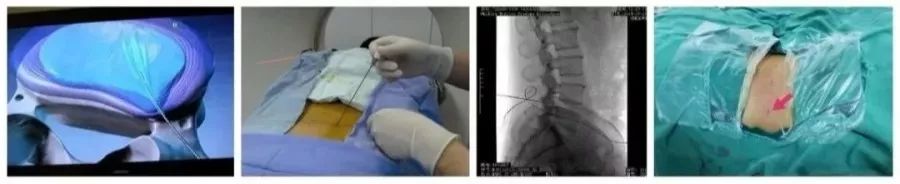 中西医结合治疗脊椎病，个性化定制治疗方案