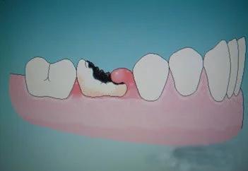 第七次拔牙的真实经历,记录我悲催的拔牙经历