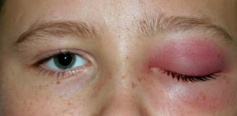 眼睑里有个红色的肿物,眼睑肿瘤的鉴别诊断单图片