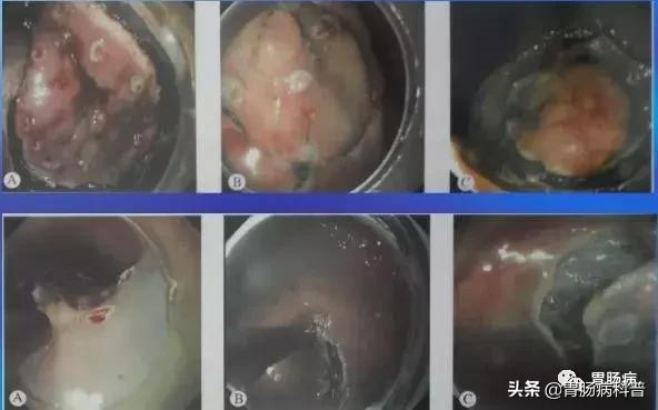 内镜下粘膜剥离术属于esd还是emr,胃肠息肉内镜下黏膜剥离术