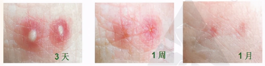 南沙|@东涌街坊,专家建议,红火蚁得这样治