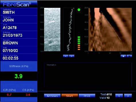 肝穿刺可以查到肝硬化的原因吗,肝穿刺能检查出肝硬化了吗