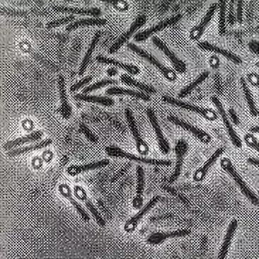 家用指甲钳拔牙,拔牙感染险些丧命