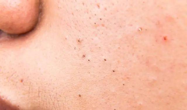 出油毛孔粗大闭口黑头怎么治,脸上有黑头毛孔粗湿敷