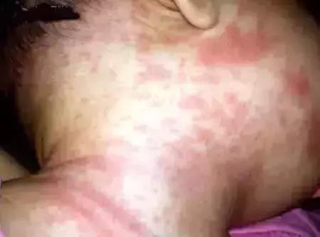 幼儿急疹和痱子怎么区分,宝宝急疹和痱子的区别