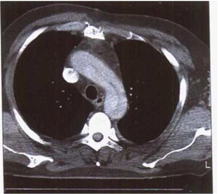急性心肌梗死的做法,内科主治心肌梗死视频