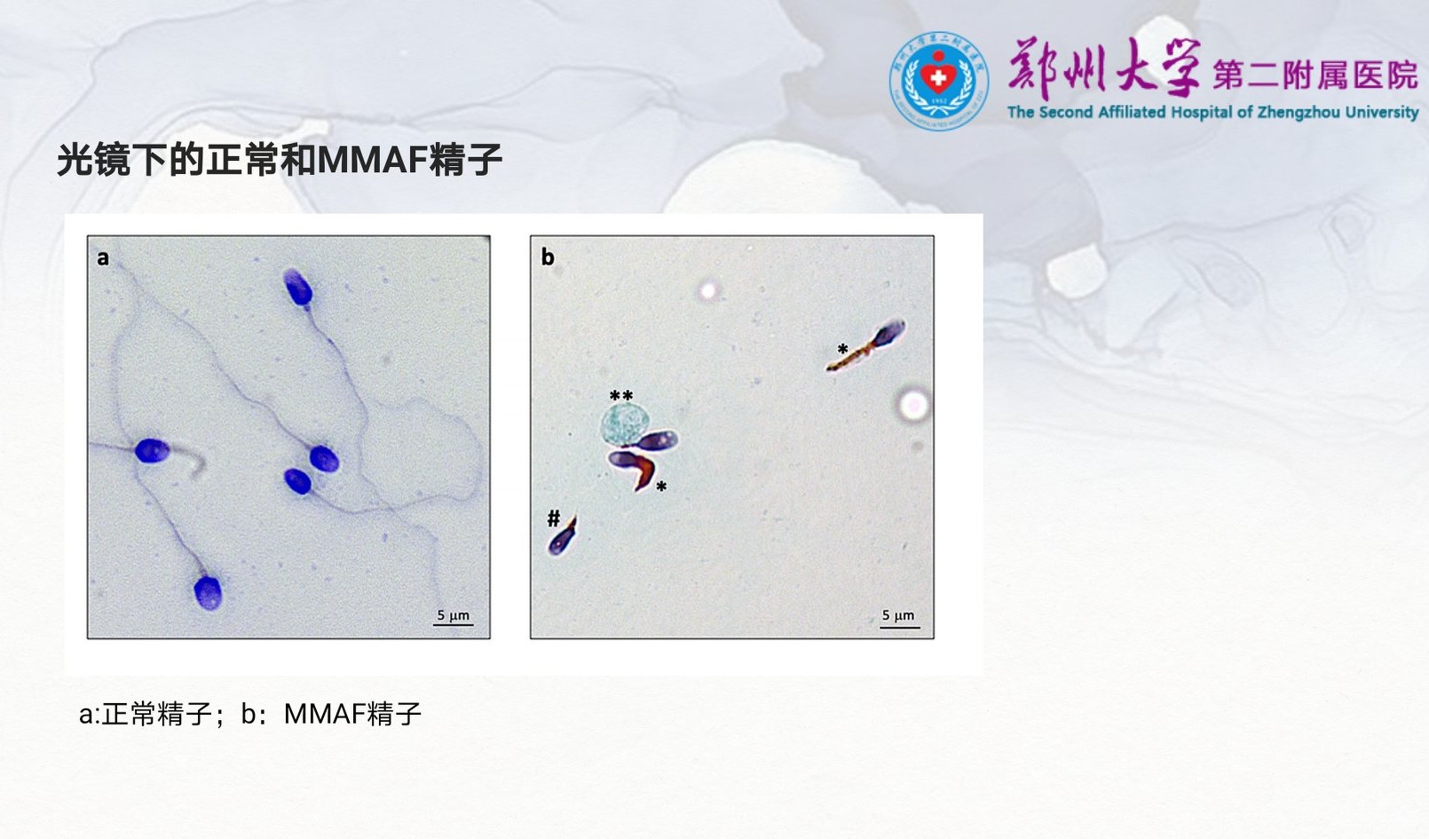严重弱精症原因,重度少精弱精症可能的原因