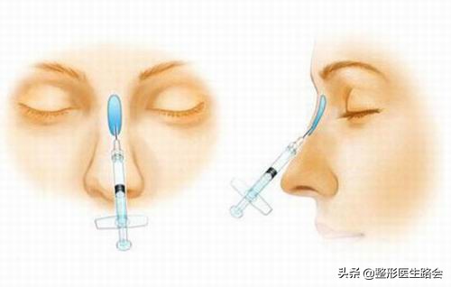 不做手术提高鼻梁的方法,不做手术鼻梁增高方法