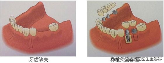 山东正规种植牙一颗大概多少钱,淄博种植牙价格多少钱啊