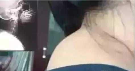 脖子后面的夺命包图片,脖子上有小包包是怎么回事