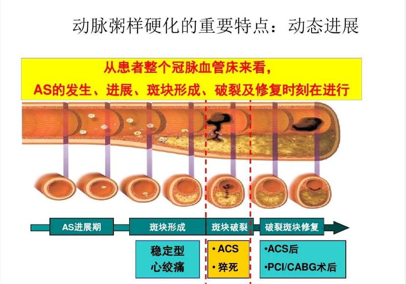 阿托伐他汀与瑞舒伐他汀的优缺点,冠心病吃辛伐他汀还是瑞舒伐他汀