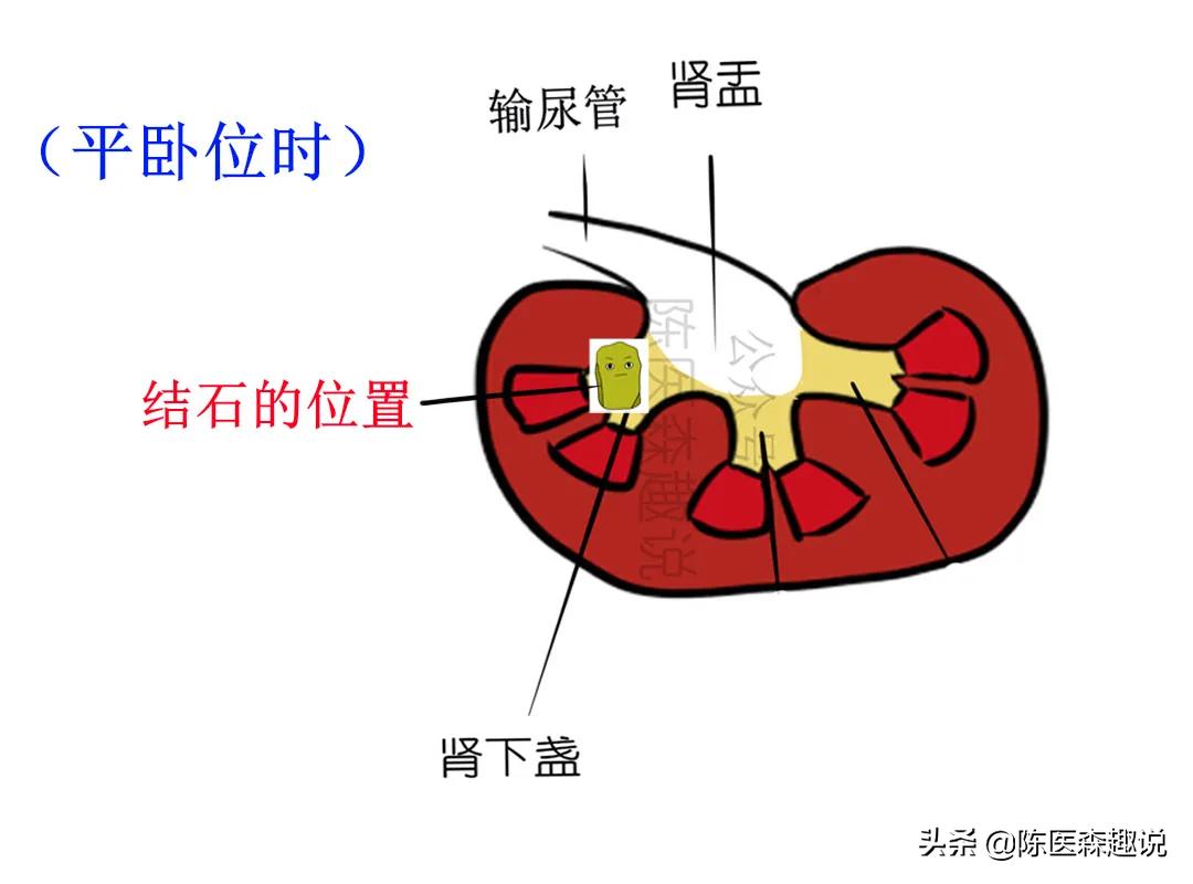 肾下盏结石怎么能排出来,左肾结石6mm多久能自然排出