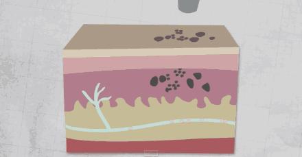 激光类美容项目,各种激光适应症