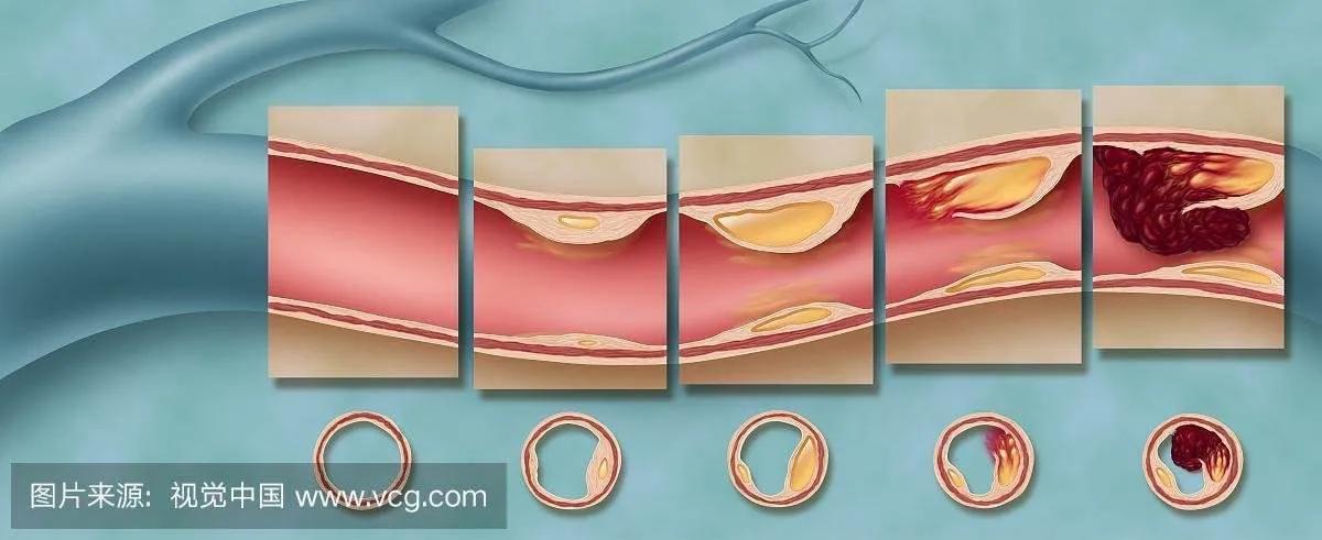 北大维信血脂康可以长期服用吗,血脂康能长期服用吗