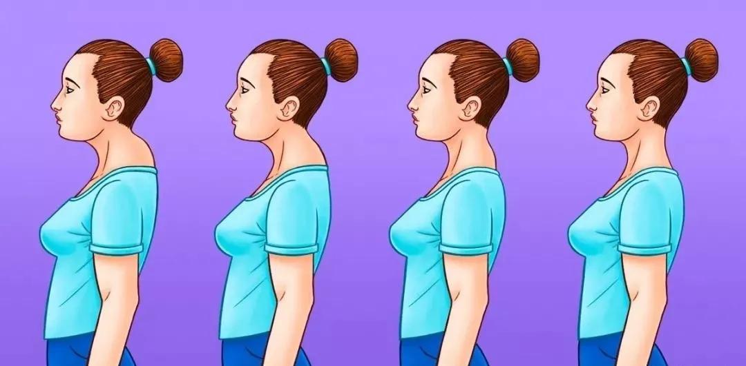 富贵包是颈椎病引起的吗,颈椎病富贵包正确锻炼视频