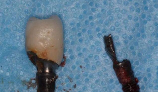 2000块的种植体你真的敢种吗?为什么会这么便宜,良心牙医告诉你