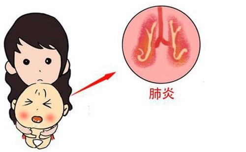 新生儿肺炎是怎么引起的怎样治疗,新生儿肺炎严重的症状有哪些