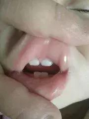 宝宝长乳牙注意事项及禁忌,一定要注意孩子的乳牙很重要
