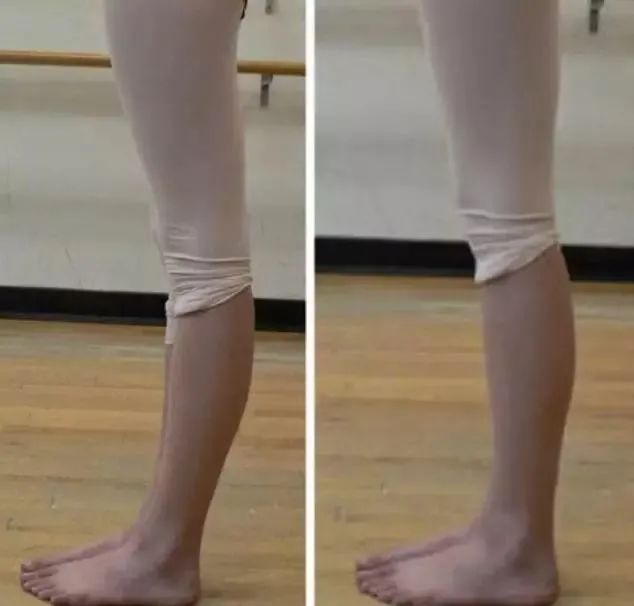 膝超伸腿粗运动可以改善吗,大粗腿膝超伸矫正方法图解