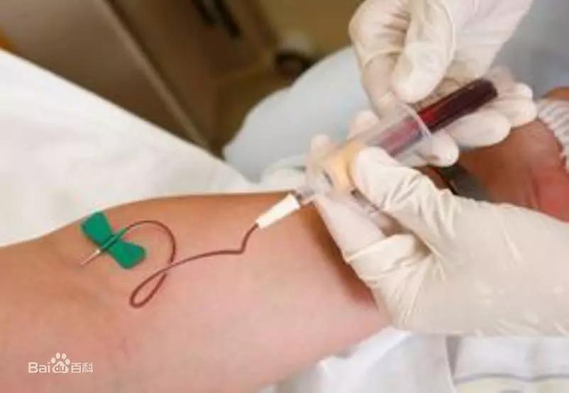 专用三棱针放血,放血用的12号三棱针