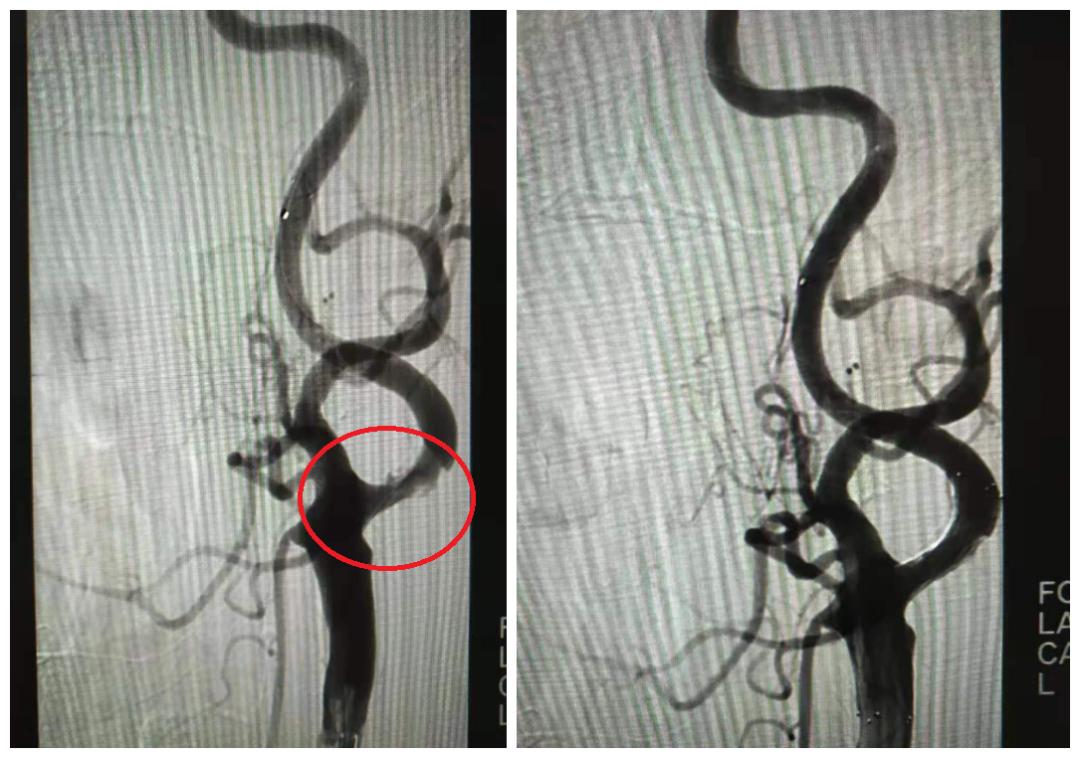 75岁老人多发性脑梗死，DSA介入治疗打通大脑“生命线”