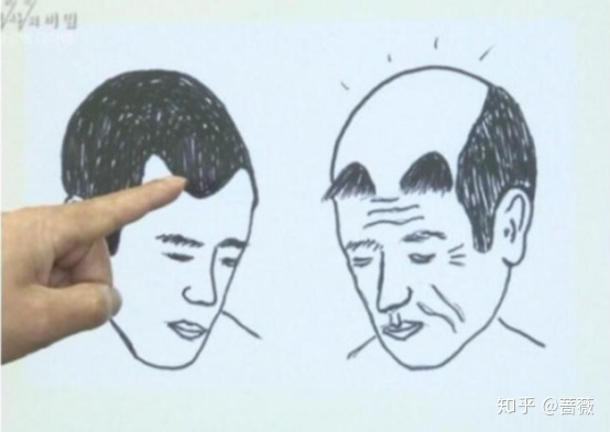 植发多年以后非植发区掉光,植发以后还可以植发吗