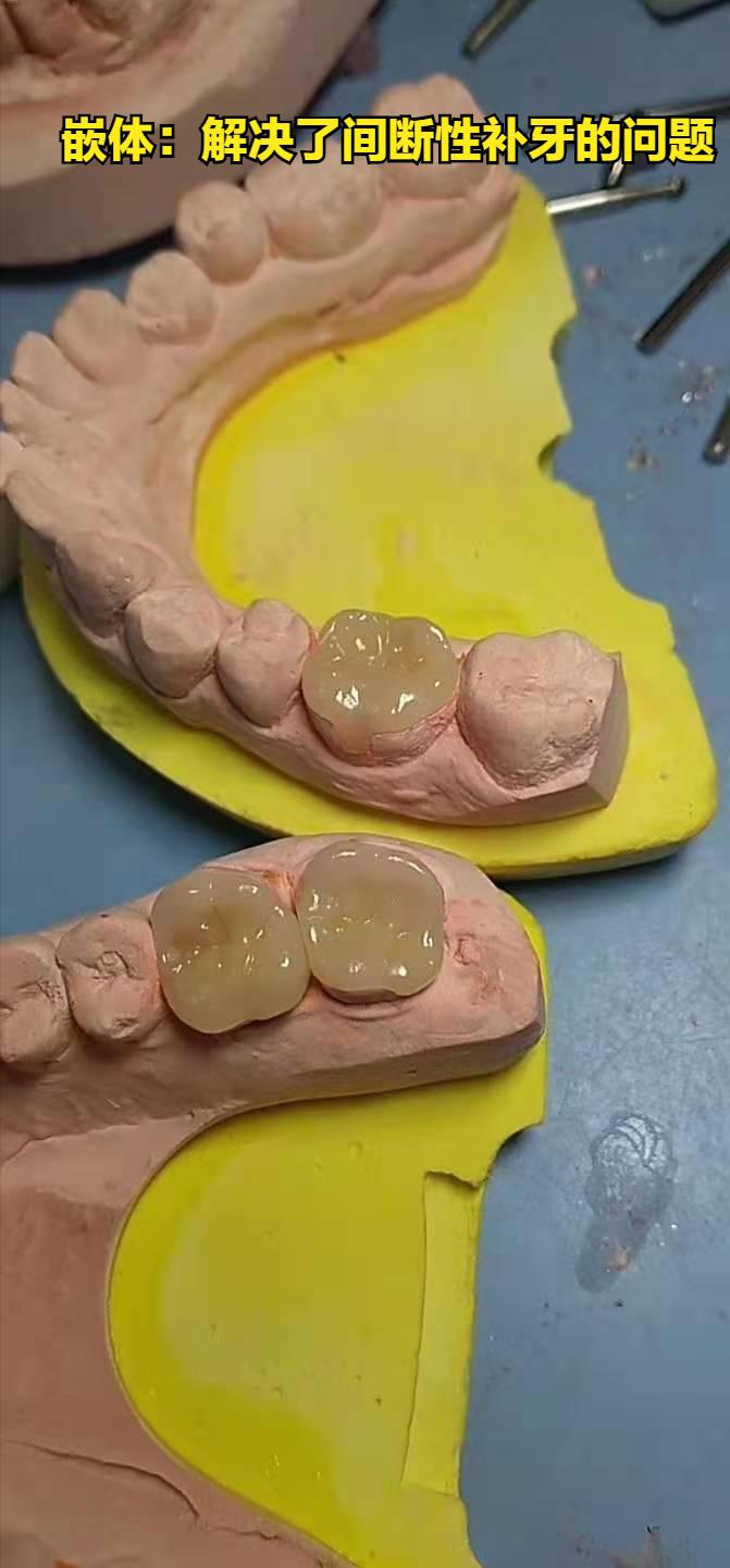假牙套怎么种植牙,戴的假牙套与全瓷牙的感觉