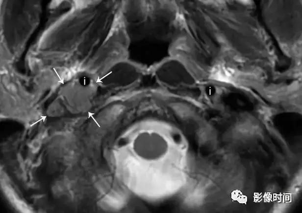 双侧颈动脉鞘间隙多发小淋巴结影,双侧颈动脉间隙多软组织密度结节