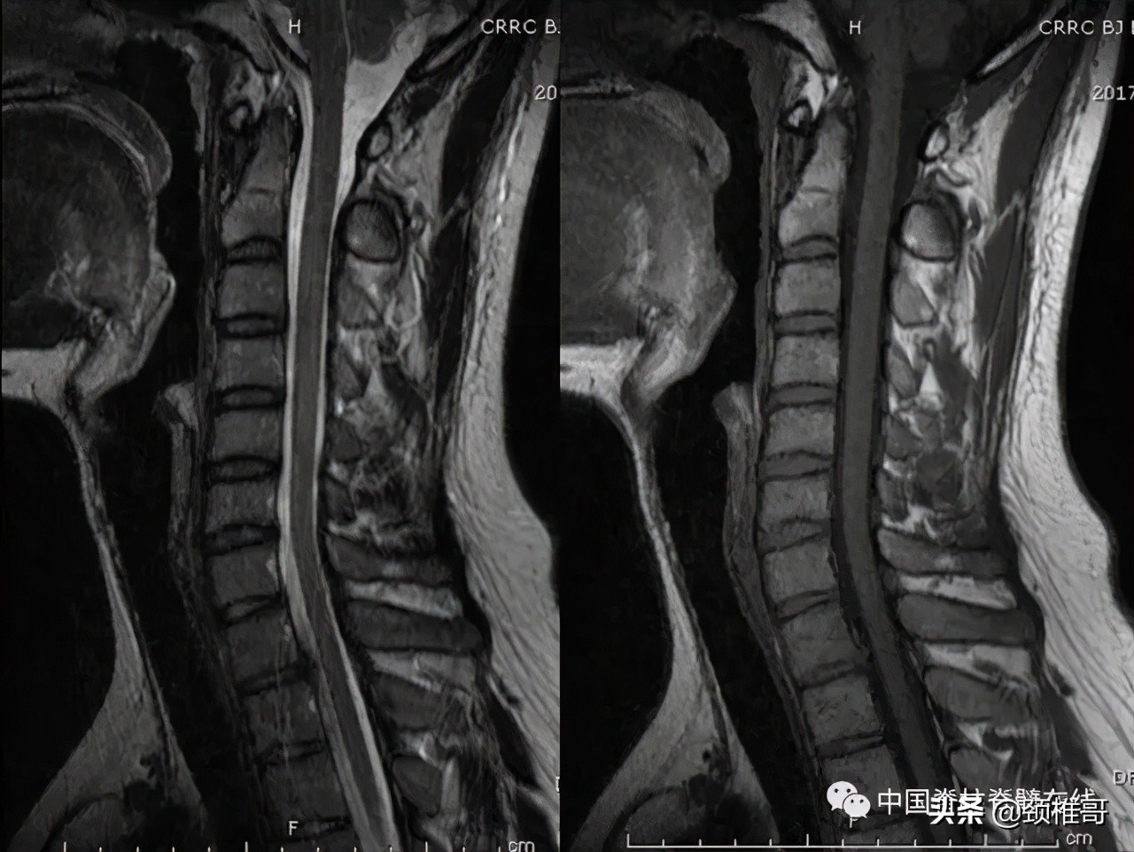 颈椎病的护理临床路径流程图,颈椎病的健康管理与康复指导
