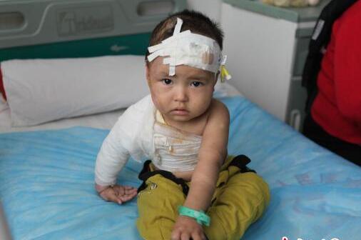 小孩被开水烫伤较严重该怎么办,开水烫伤二级严重吗