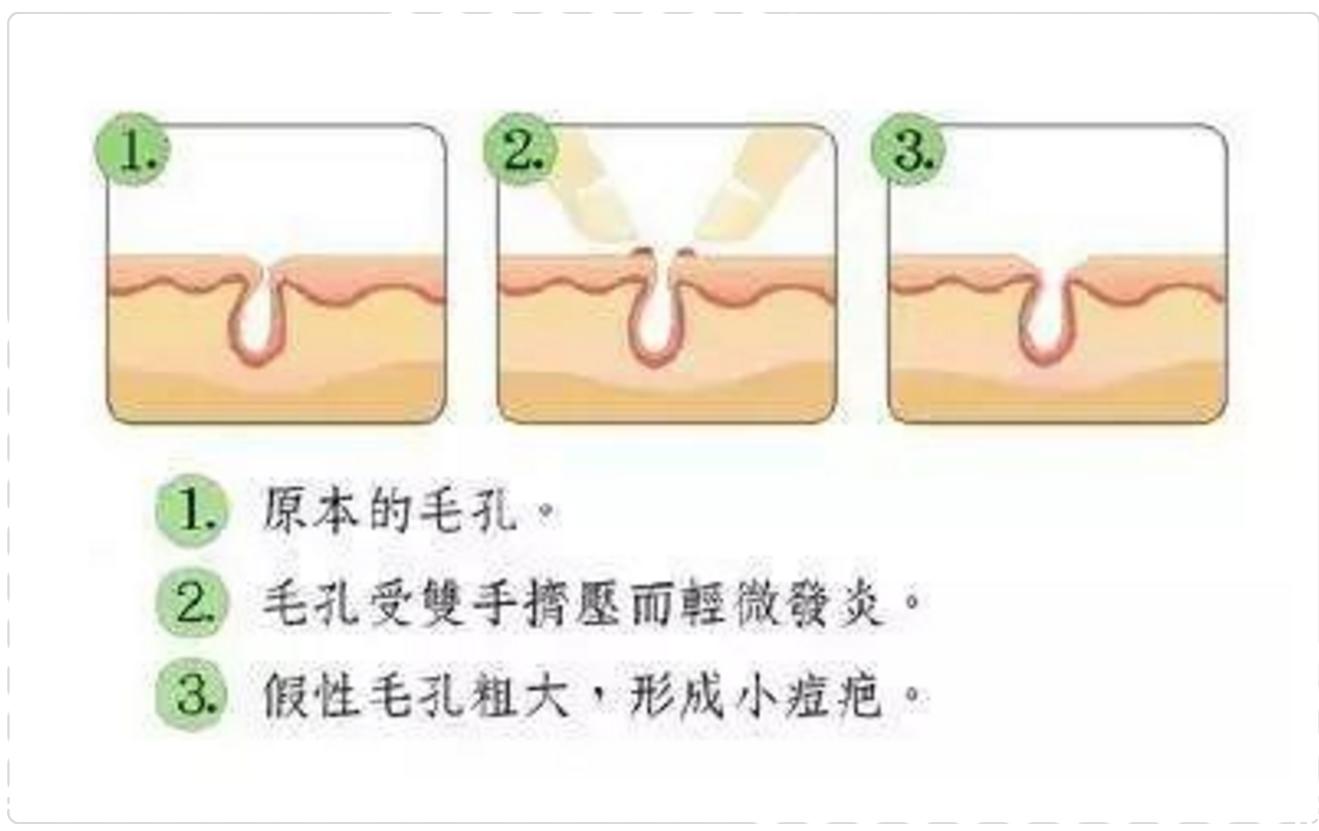 祛痘印小妙招学生党怎么祛痘印,痘印肌肤很闹心教你祛痘印小妙招